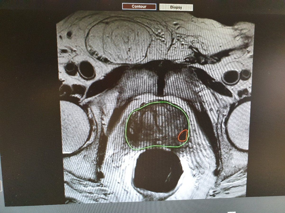 Risonanza Magnetica Multiparametrica E Diagnosi Del Tumore Alla Prostata